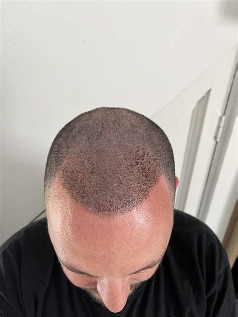 Not Happy With Hair Transplant Results? Here's What To Do