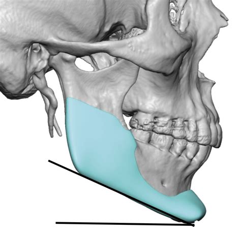 The Use Of Mandibular Plane and Gonial Angle Measurements in Custom Jawline Implant Design ...
