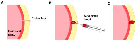 Autologous Blood Patch for Persistent Ascites Leak from Non-Closing Paracentesis Tracts
