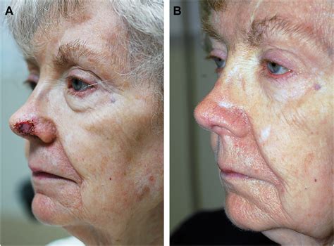 Reducing Risks of Graft Failure for Composite Skin–Cartilage Grafts - Facial Plastic Surgery Clinics