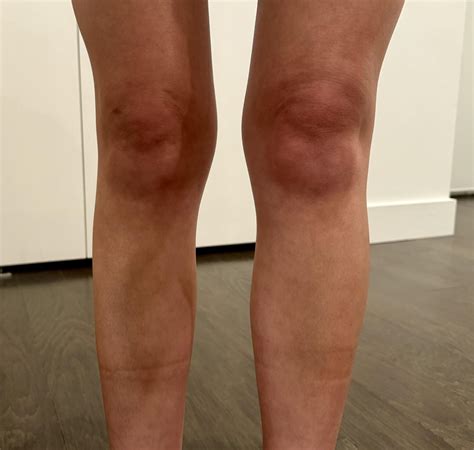 Is having this much swelling / fluid in my knees "normal"? : r/Autoimmune