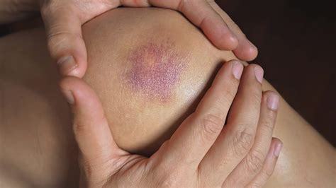 Do muscle strain bruise? - ANF Academy
