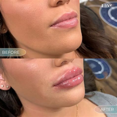 Lip Filler Before And After | Natural Results In Orlando, FL