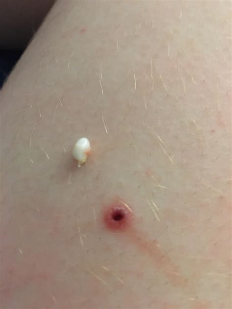 Popped what may be a small skin cyst out my leg | Scrolller