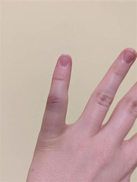Pinky bent backwards at a sports competition. Should I get it checked out? : r/medical_advice