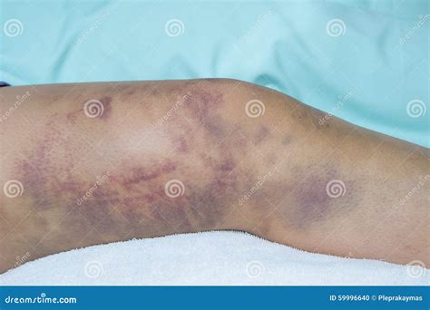 Contusion Of The Thigh