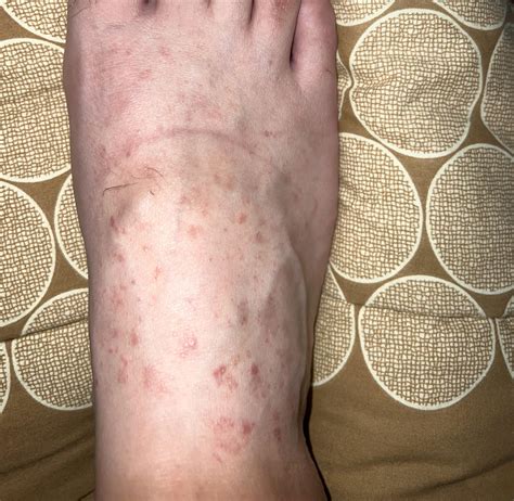 Derma diagnosed this as pityriasis rosea. Concerned that it could be something else? : r ...