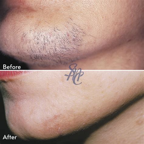 Laser Hair Removal - Suffolk Medical & Beauty Clinic