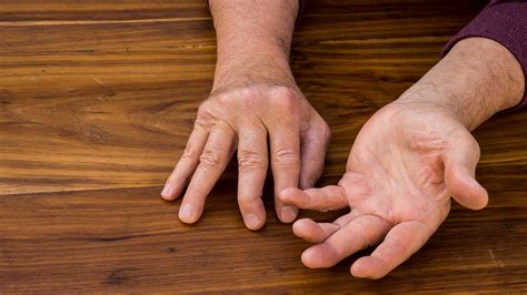 Do You Get Disability Benefits for Psoriatic Arthritis? - GoodRx