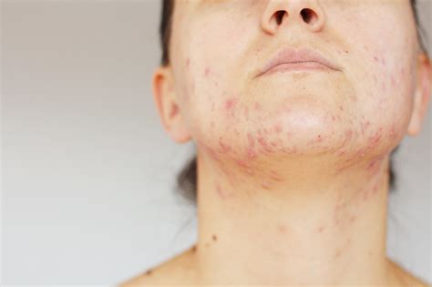 Chin Acne Causes, Painful, Hormonal, Around under Chin & Treatments - American Celiac