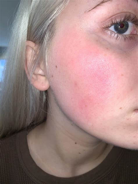 Chemical Burn On Face