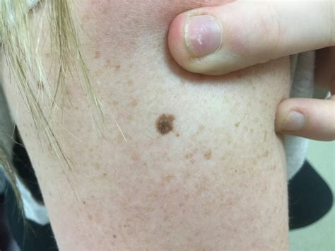 Types Of Abnormal Moles