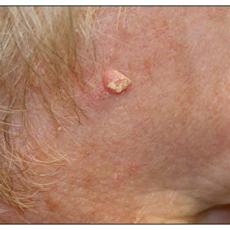 Skin Cancer: Malignant vs. Benign | Kaggle