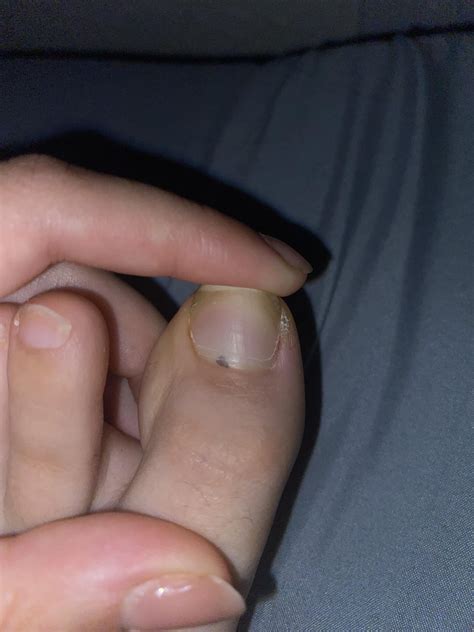 black spot on toe nail, what is this? : r/Dermatology