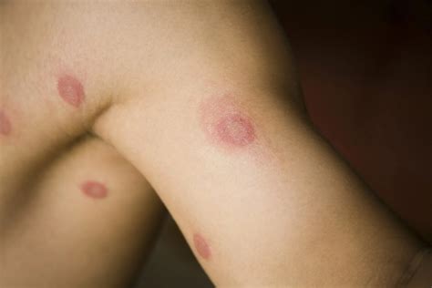 Eczema vs. Ringworm: How to Tell the Difference — Global Parents for Eczema Research
