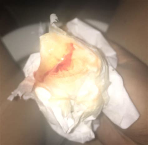 Why Is My Discharge Mustard Yellow at Jayden Nobbs blog