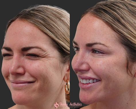 Botox Before and After Results - Everything You Need to See & Know