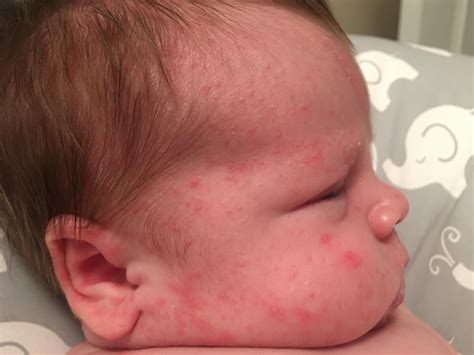 Little Red Spots On Newborn
