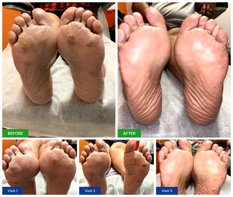 Plantar Wart Treatment - New Horizons Foot and Ankle Associates
