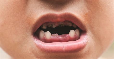 IDENTIFY TOOTH DECAY - The Dental Ark El Paso