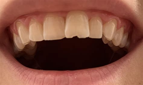 How to handle this chipped front tooth? : r/askdentists