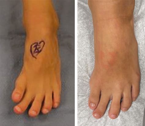 View of Physiolysis for Metatarsal Bracketed Epiphysis | Journal of the ...