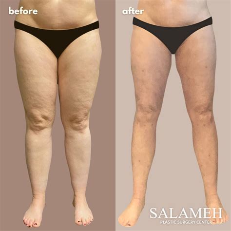 Lipedema vs. Cellulite: Understanding the Differences & Treatment Options