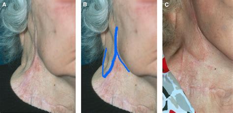 Creative uses of the Z-plasty technique - Operative Techniques in ...