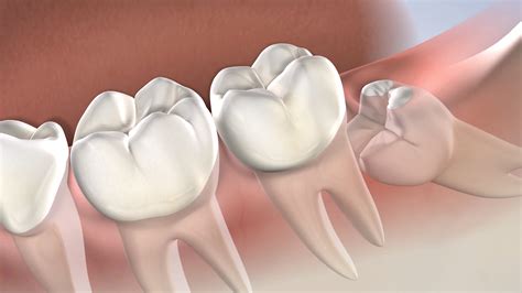 Post-Operative Instructions: Wisdom Teeth Removal