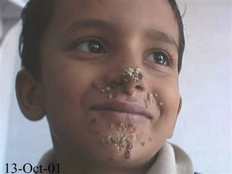 Impetigo Contagiosa | PPT