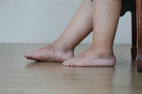 Burning Sensation in Leg Below Knee: Causes & Treatment Options