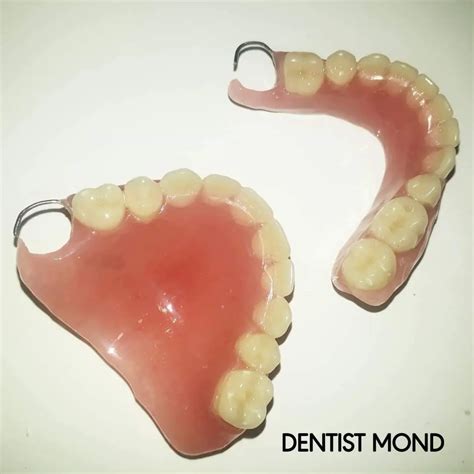 Placa de acrílico odontológico: protección dental eficaz | POLISANTAFE