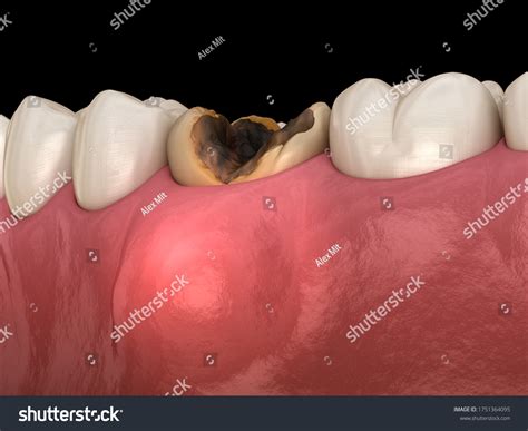 454 Dental cyst Images, Stock Photos & Vectors | Shutterstock