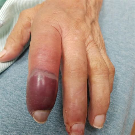 BLISTERING DISTAL DACTYLITIS - Stamford Skin Centre