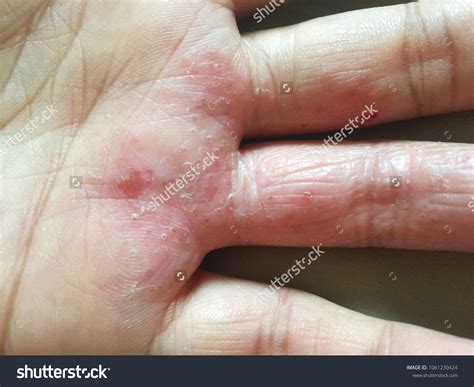 Finger Fungal Infection