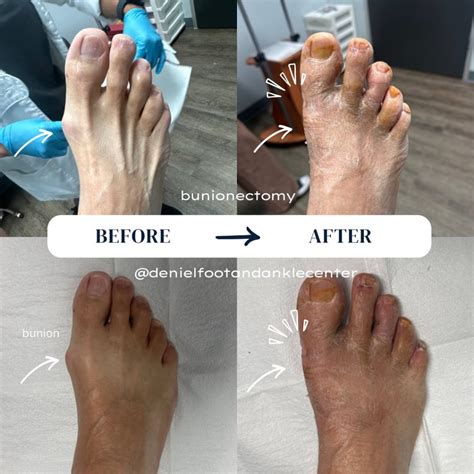 Minimally Invasive Bunion Surgery: A Step Towards Pain-Free Feet!