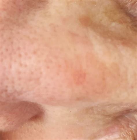 Actinic Keratosis Warning Signs and Images