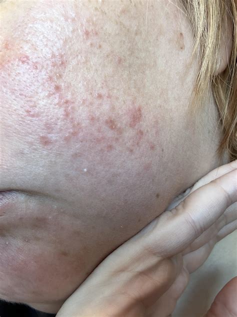 At my wits end! Is this FA? : r/Fungalacne