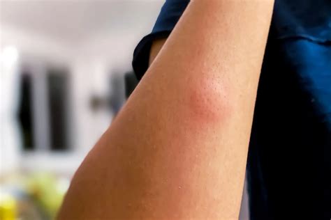 Mosquito Bites Swelling Frontiers | Update On Mosquito Bite Reaction: