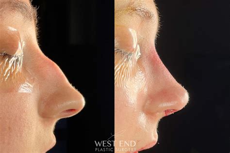Nose Job Surgery