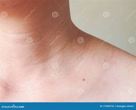 Skin tags. stock image. Image of problem, medical, female - 179389755