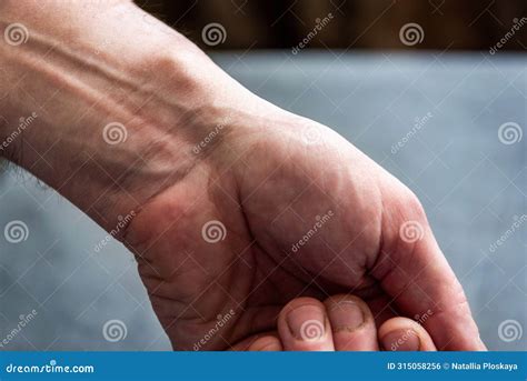 Wrist Ganglion Cyst Disease , Ganglion Cyst , A Fluid-filled Lump Under The Skin , Pain Hand ...