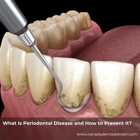 What Is Periodontal Disease and How to Prevent It?