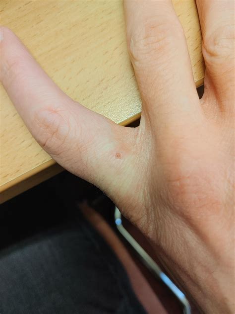 Black dot after salyclic acid : r/Warts