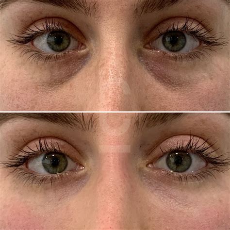 Botox Before And After Under Eyes Botox Under Eyes, Under Eye Bags