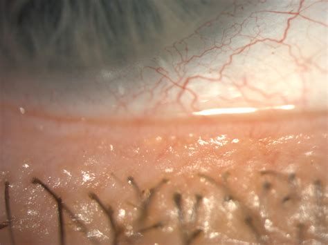 Meibomian Gland Dysfunction - Scope Connect