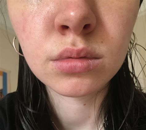 [Skin Concern] I know it isn't that noticeable but there is a slight redness on my left cheek I ...