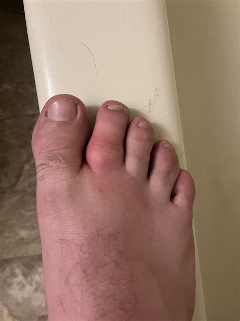 Swollen toe, noticed swelling yesterday, mild pain this morning. Happened to have an Orthopedics ...