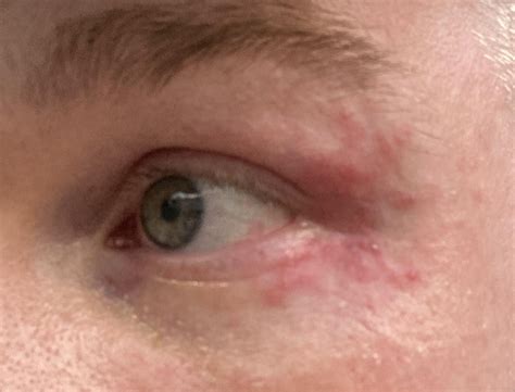 Triggers for periorbital dermatitis? : r/Perioral_Dermatitis_