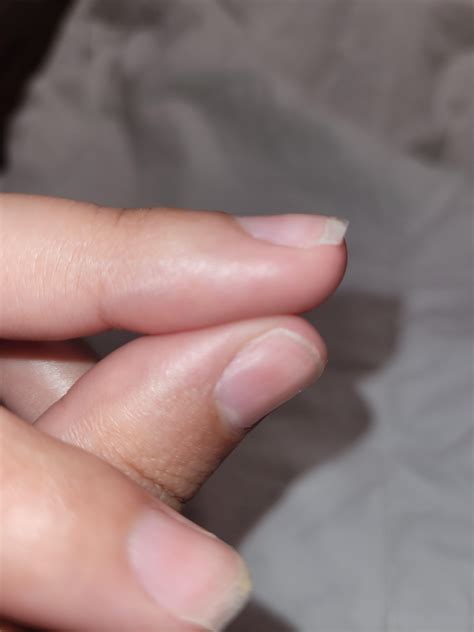 Almost all my nails have this weird bump in them. Could this be a sign ...